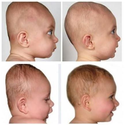 Almohadas para ayudar a prevenir y tratar la plagiocefalia en bebés -  mispequeaventuras